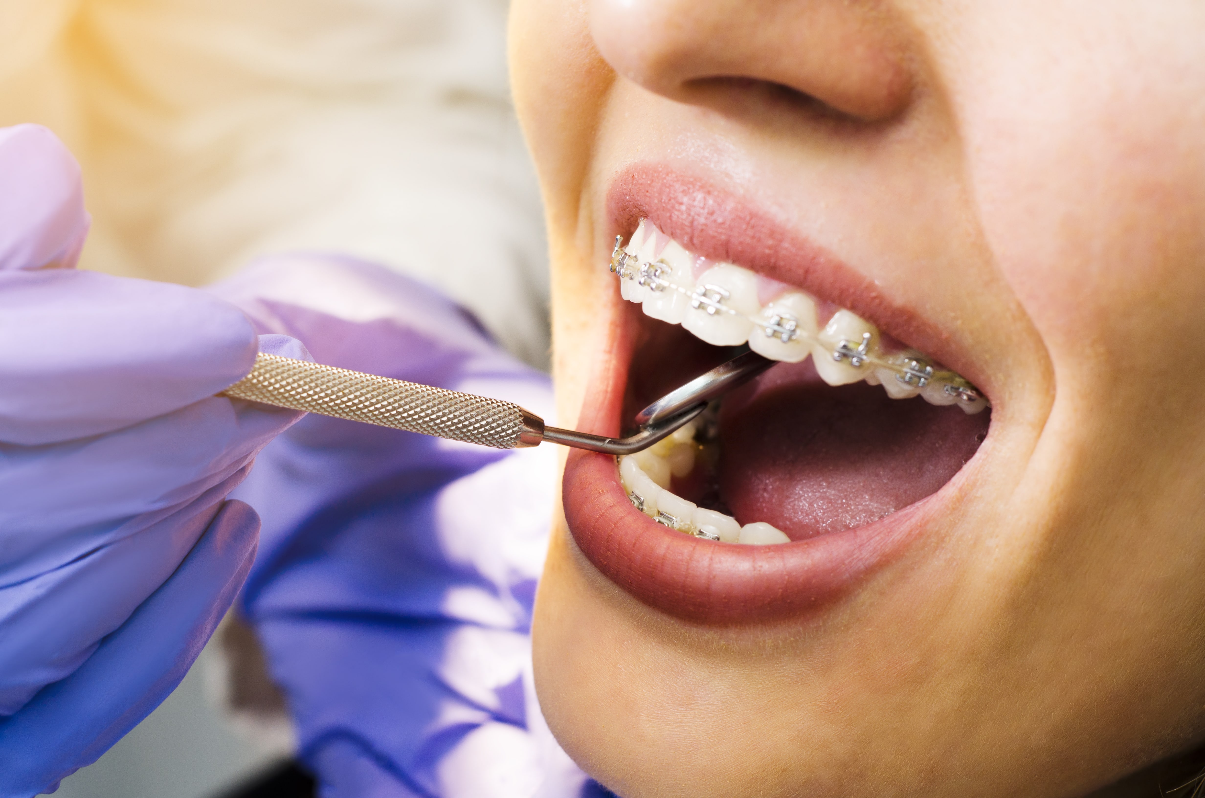 Dental Brace